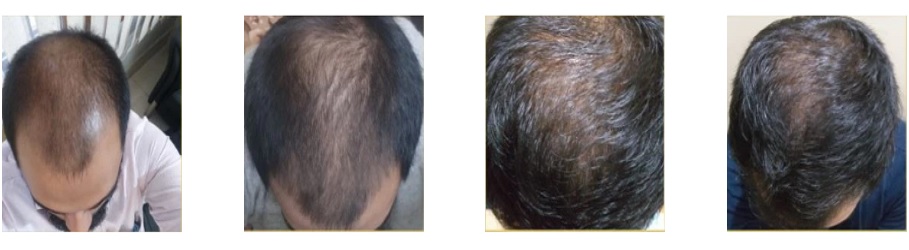 Hair Loss: Traya Health’s treatment emerges as a game changer